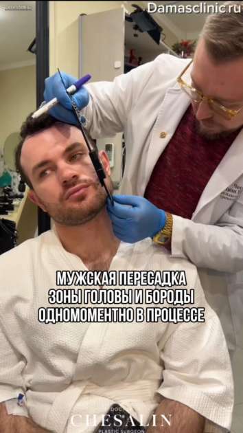 Отзыв пациента после пересадки бороды, видео пересадки и фото результатов