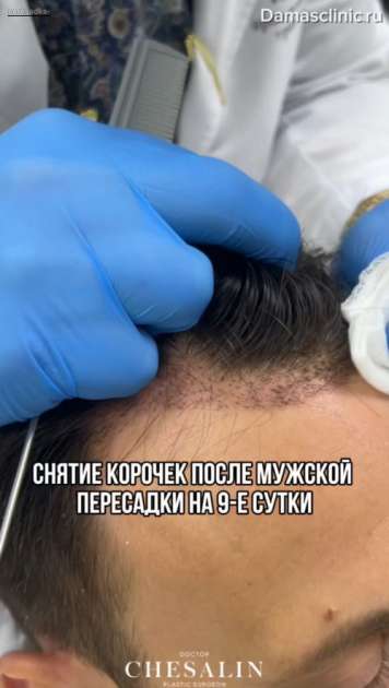 Снятие корочек после мужской пересадки на 9-е сутки. Нюансы реабилитации после мужской пересадки волос в видео