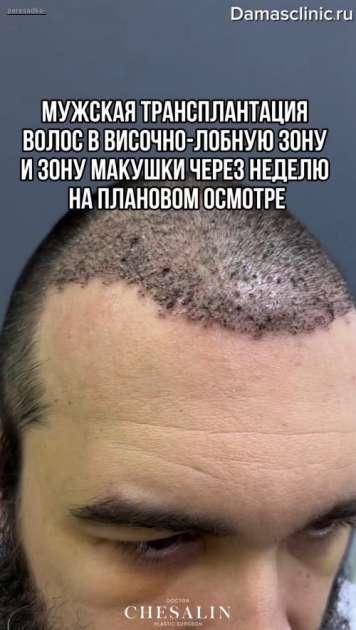Мужская трансплантация волос в височно-лобную зону и зону макушки через неделю на плановом осмотре с видео-результатом