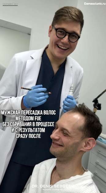 Пересадка волос методом FUE в височно-лобную зону в процессе с комментариями и с результатом сразу после