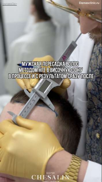 Мужская пересадка волос методом HFE в височную зону в процессе и с фото-результатом сразу после