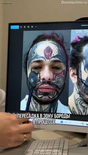 Трансплантация в зону бороды с фото и видео