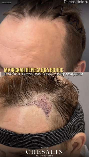 Мужская пересадка без сбривания волос методом HFE с видео-результатом