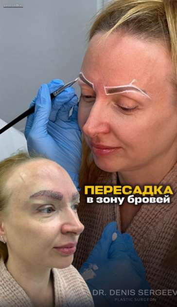 Пересадка в зону бровей при почти тотальном отсутствии волосков до в процессе и с результатом сразу после