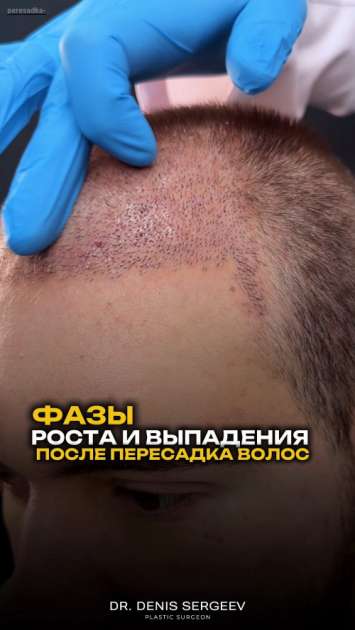 Как выпадают волосы после пересадки по фазам и что такое «шоковое выпадение волос»